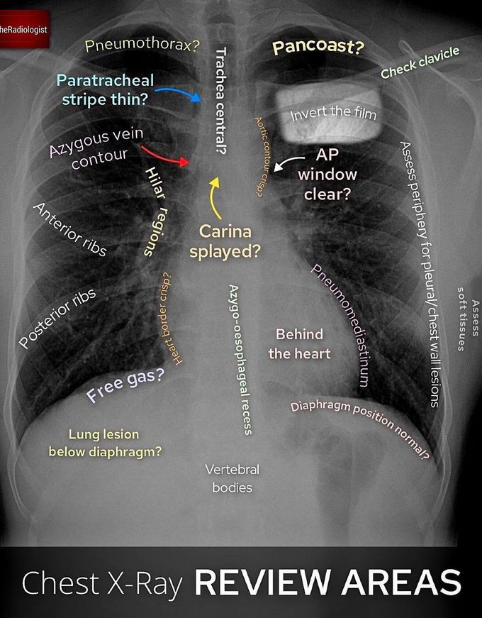 Basic Chest X-ray Review