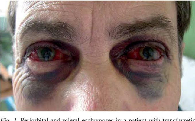 Periorbital hematoma