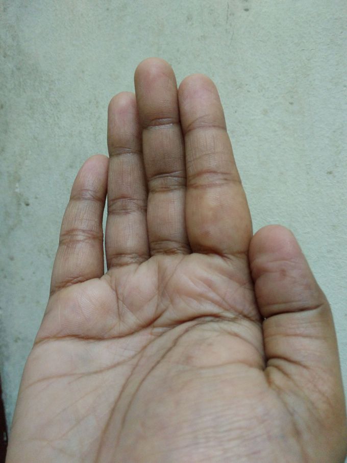 Swollen finger