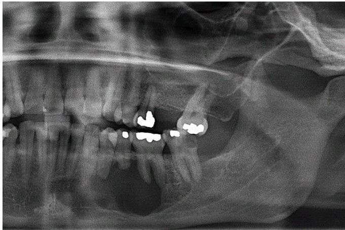 Ameloblastoma Radiograph