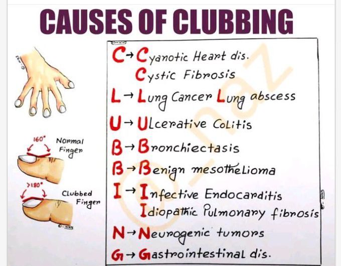 Clubbing - MEDizzy