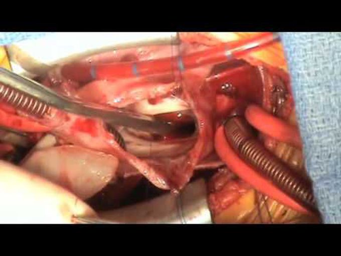 Secundum ASD Atrial Septal Defect Repair