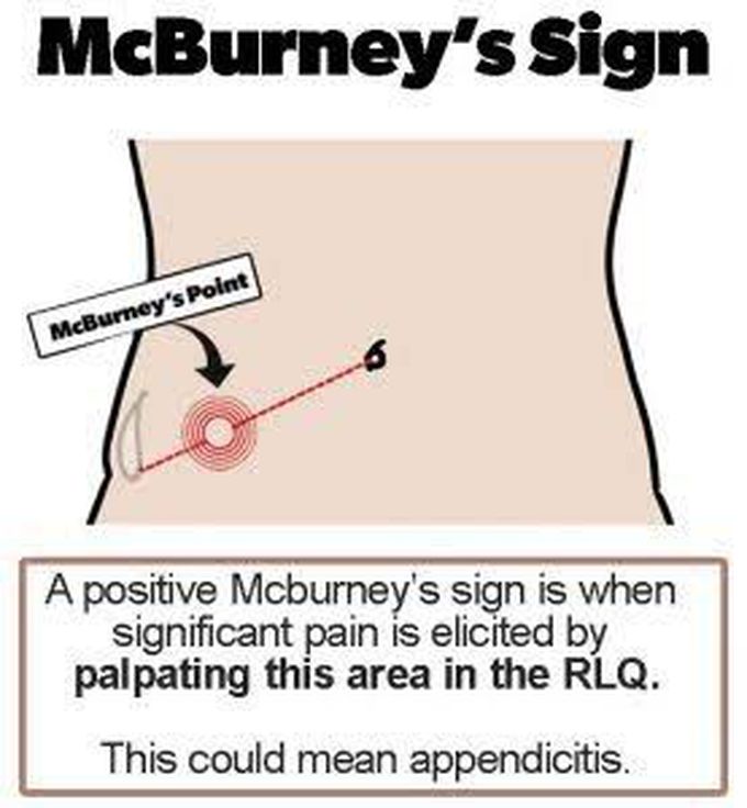 McBurney's Sign