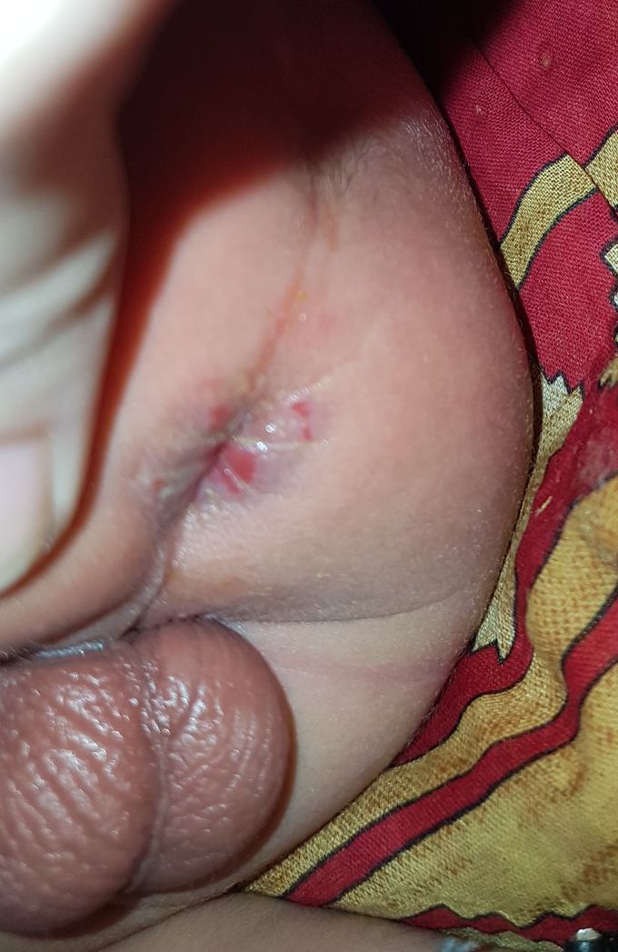 14 days old babywith Excoriating personal lesions DD?
