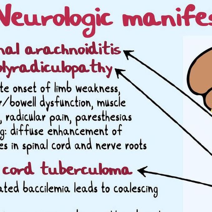 Tuberculosis