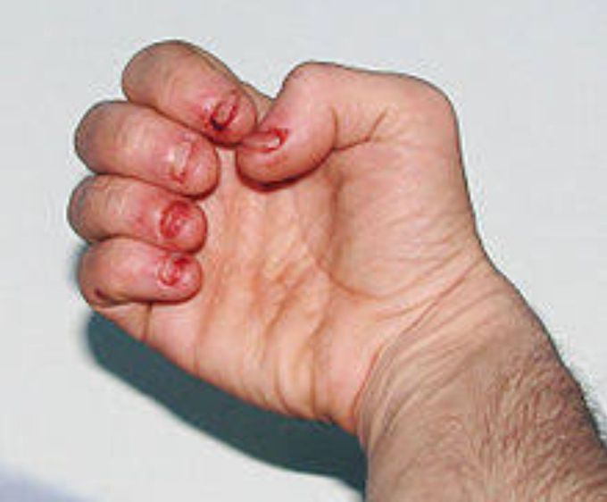 Lesch Nyhan syndrome