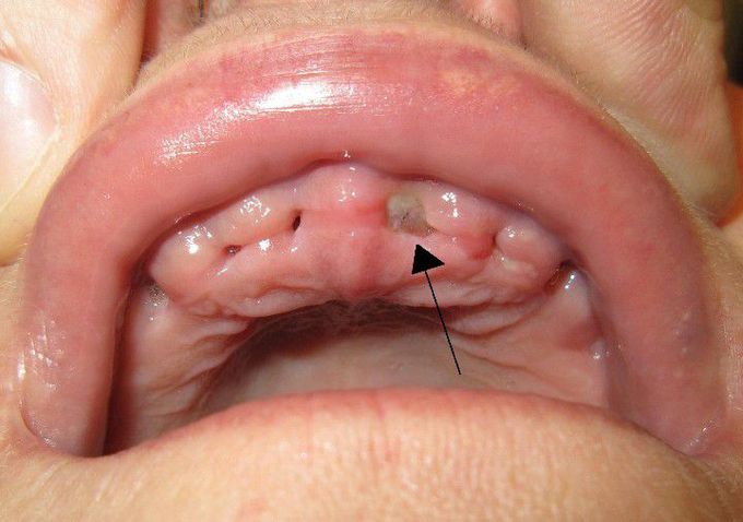 Dry socket