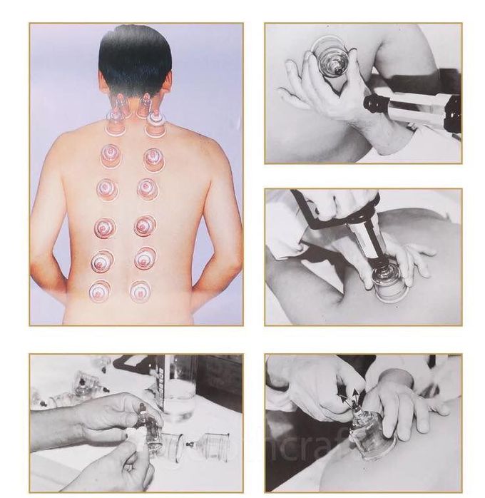 Your opinion about Cupping?