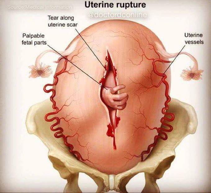 Cureus  Rupture of Unscarred Uterus With Intestinal Prolapse From