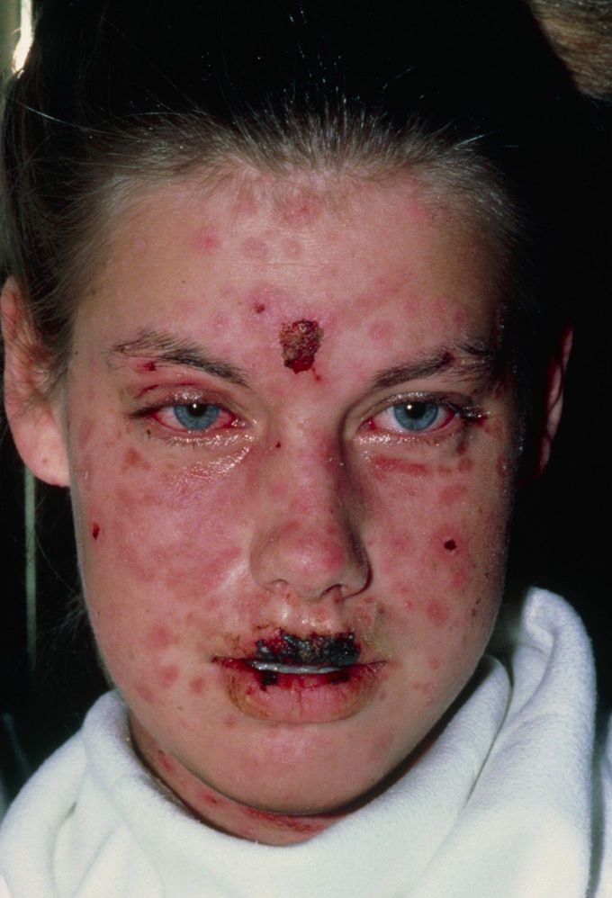 Stevens-Johnson Syndrome