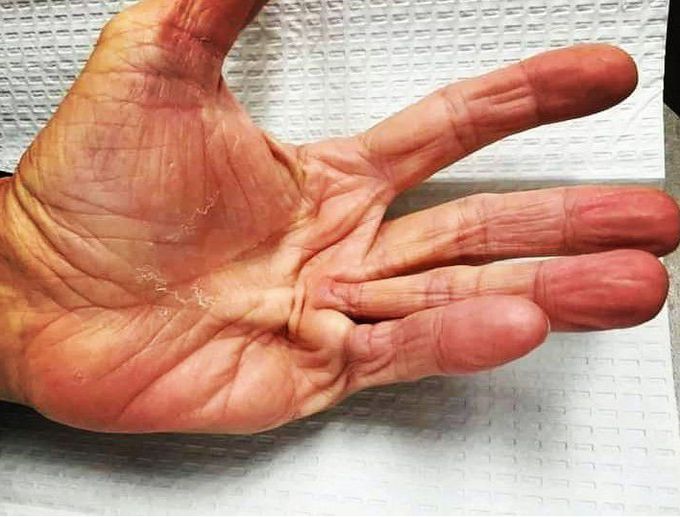 Dupuytren's Contracture