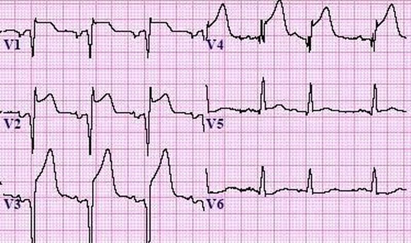 ECG changes in acute MI - MEDizzy