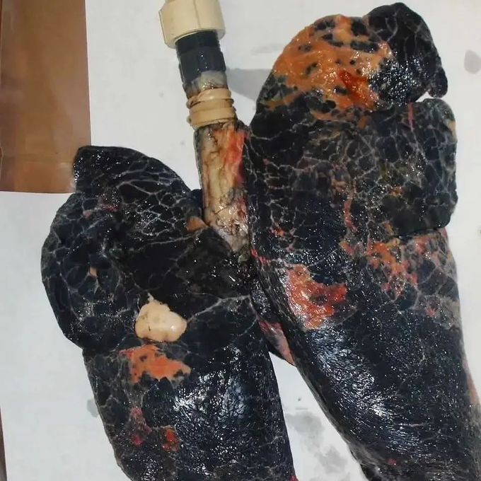 Charcoal Lungs of a heavy smoker