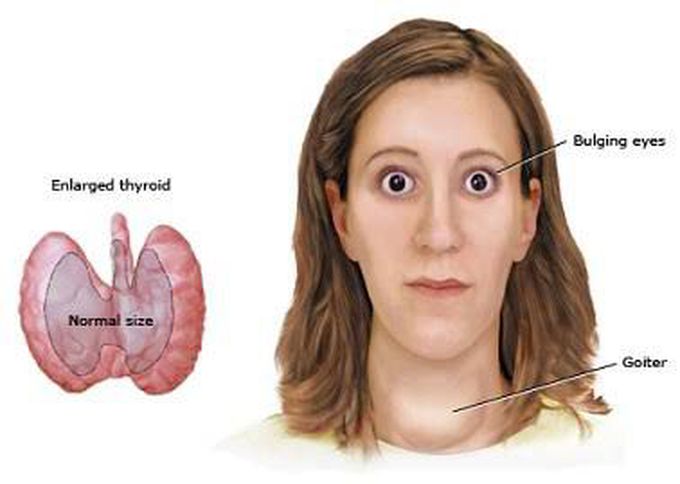 Causes of hyperthyroidism