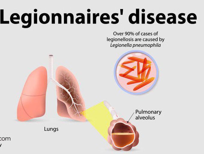 Legionnaires' disease.