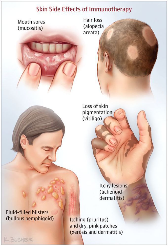 Immunotherapy side effects - MEDizzy