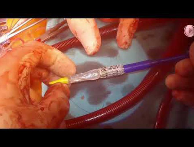 Transcatheter Aortic Valve Implantation in Patient With Severe Mitral Annular Calcification
