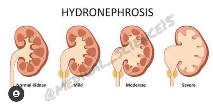 Hydronephrosis