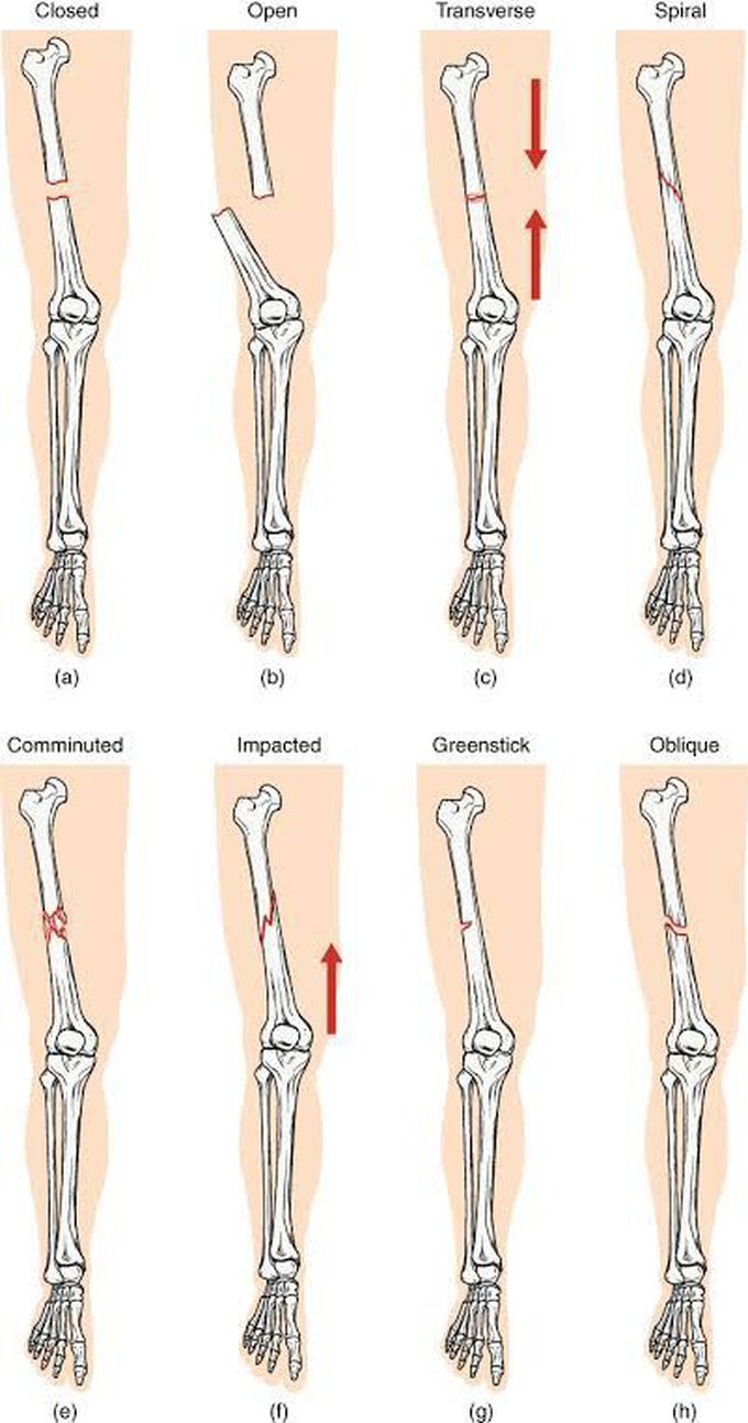 Fracture of limb