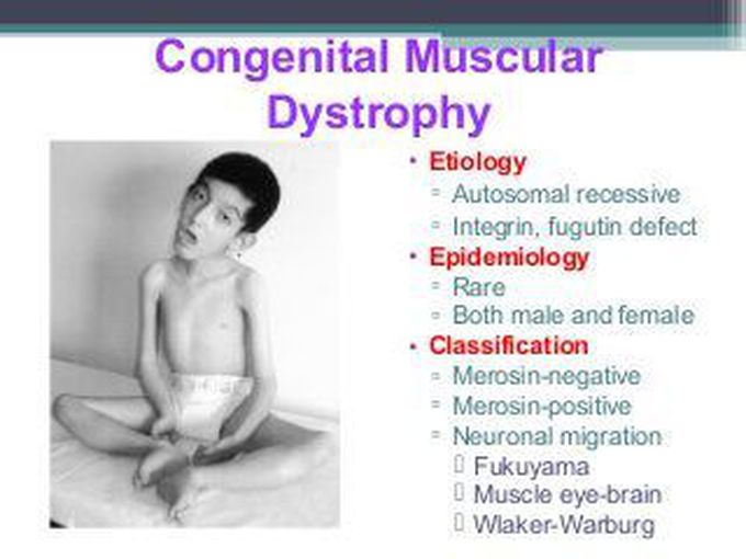 Congenital Muscular Dystrophy Cmd Medizzy 2163