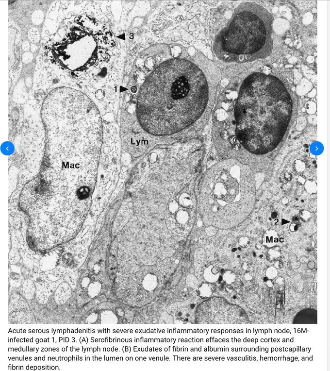 Acute lymphadenitis