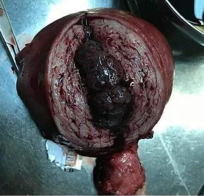 Molar pregnancy