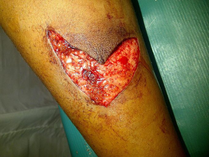 LOVE WOUND 