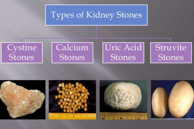 Types of kidney stones.