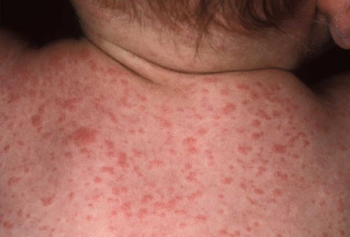 Rose Spots in Typhoid