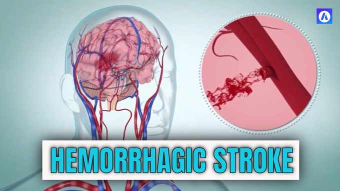 Hemorrhagic stroke: causes, symptoms and diagnosis, treatment options
