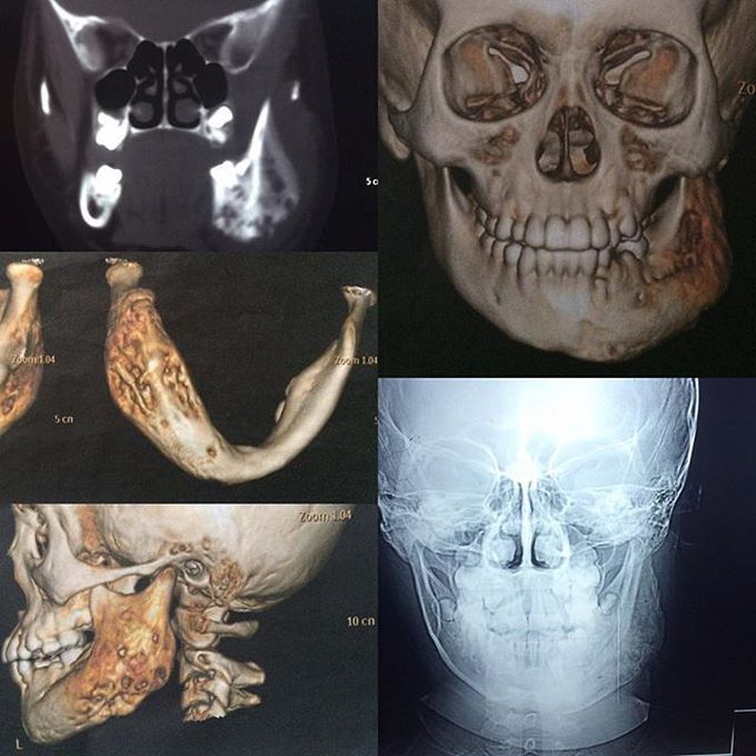 Left mandible tumor in young boy