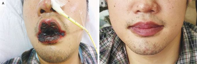 Mycoplasma pneumoniae–Associated Mucositis
