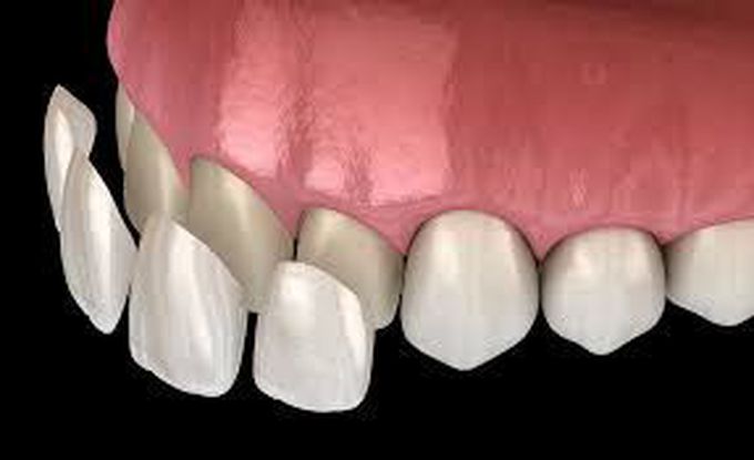 Pros and Cons of Veneers