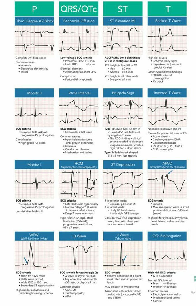 ECG findings