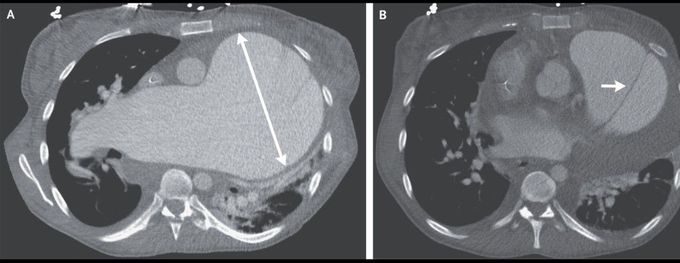 Pulmonary-Artery Aneurysm with Acute Dissection