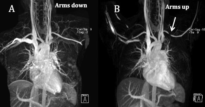 Thoracic Outlet Syndrome (TOS)