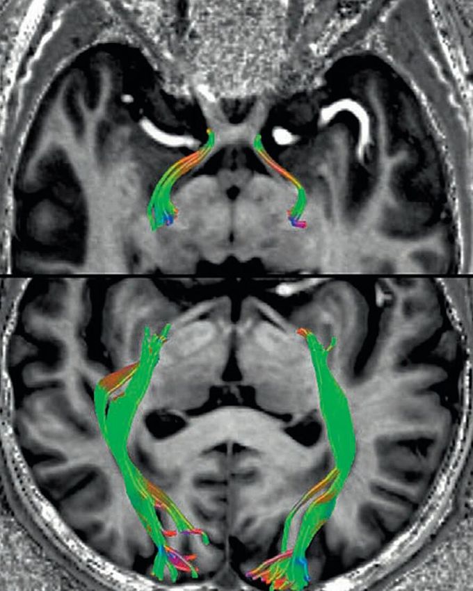 Selective tractography of the optic tract.