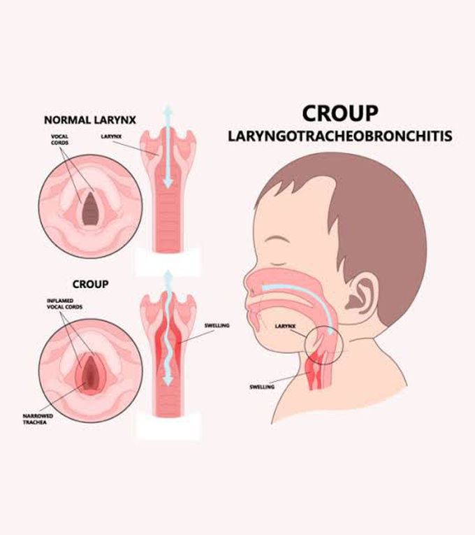 Croup