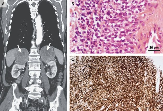 Primary Adrenal Lymphoma