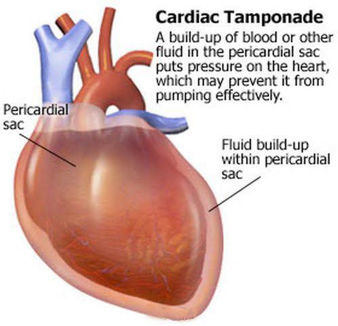 Cardiac temponade
