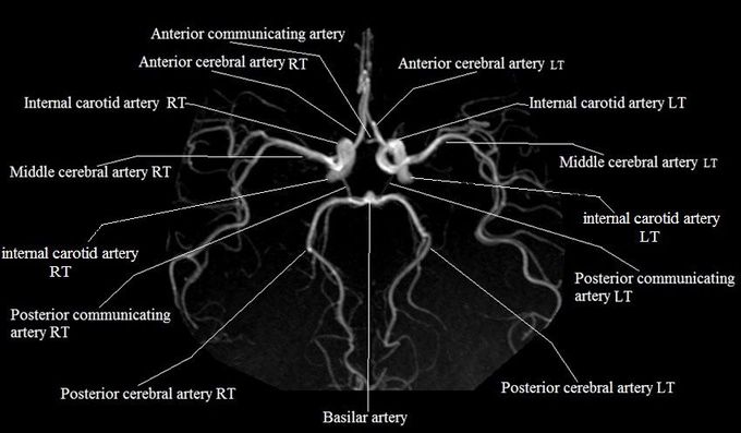 Arteries in brain. Circle of willis