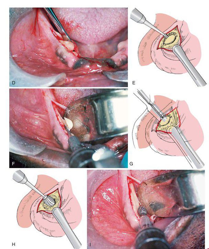 Removal of mandibular tori