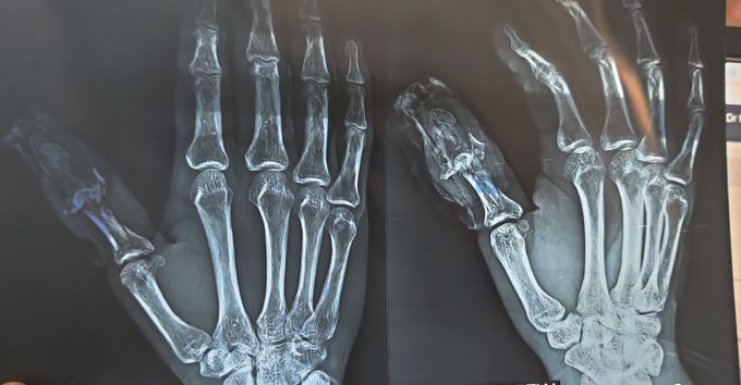 Traumatic Injury to Thumb