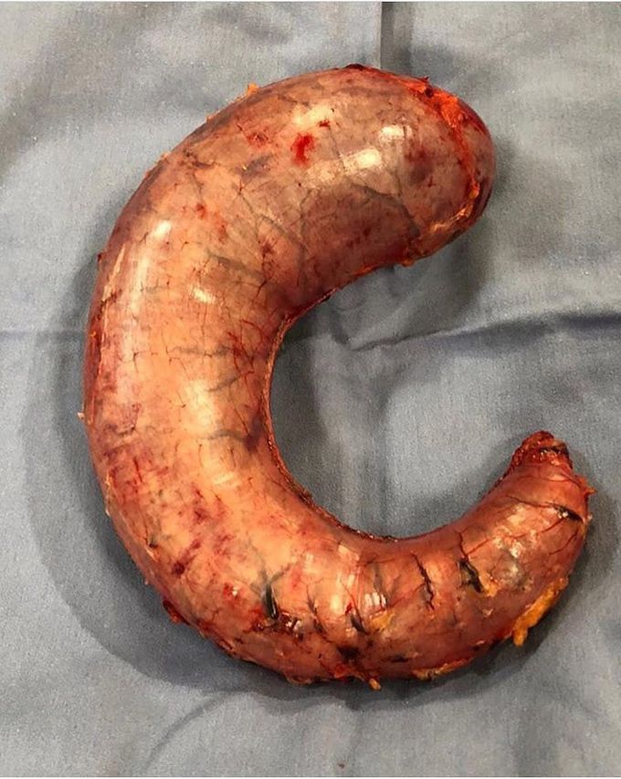 Sleeve Gastrectomy!  