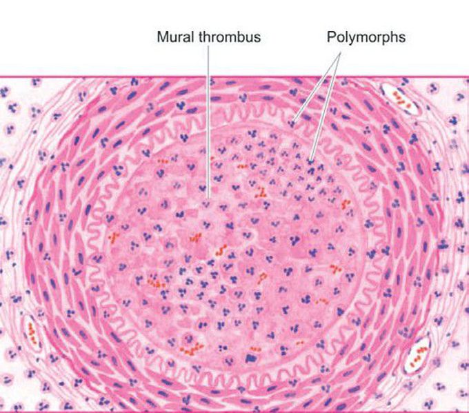 Buerger’s disease