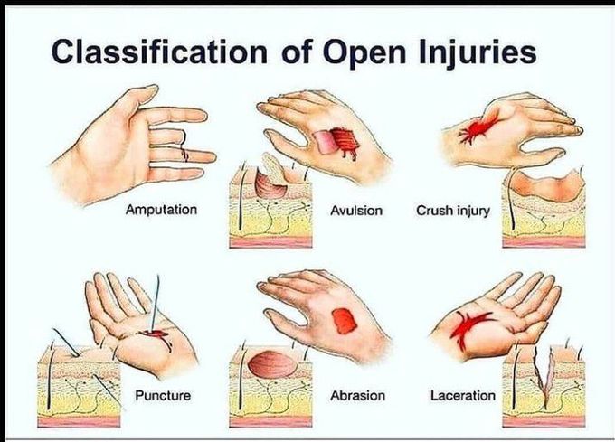 Classification of open injuries