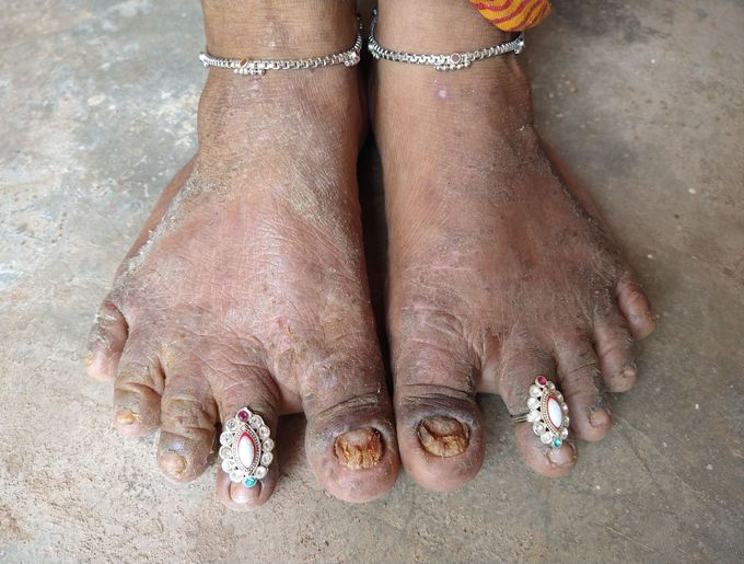 What is the name of Disease
