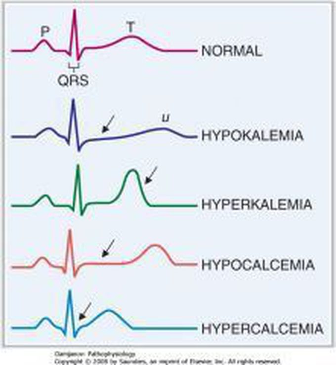 Arrhythmia