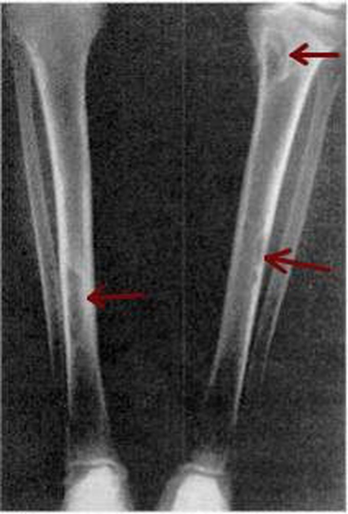 Osteitis Fibrosa Cystica