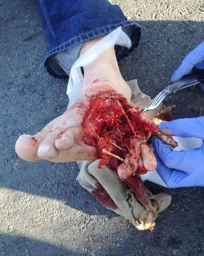 ⚠️ Horrible case of a motorcycle accident!  